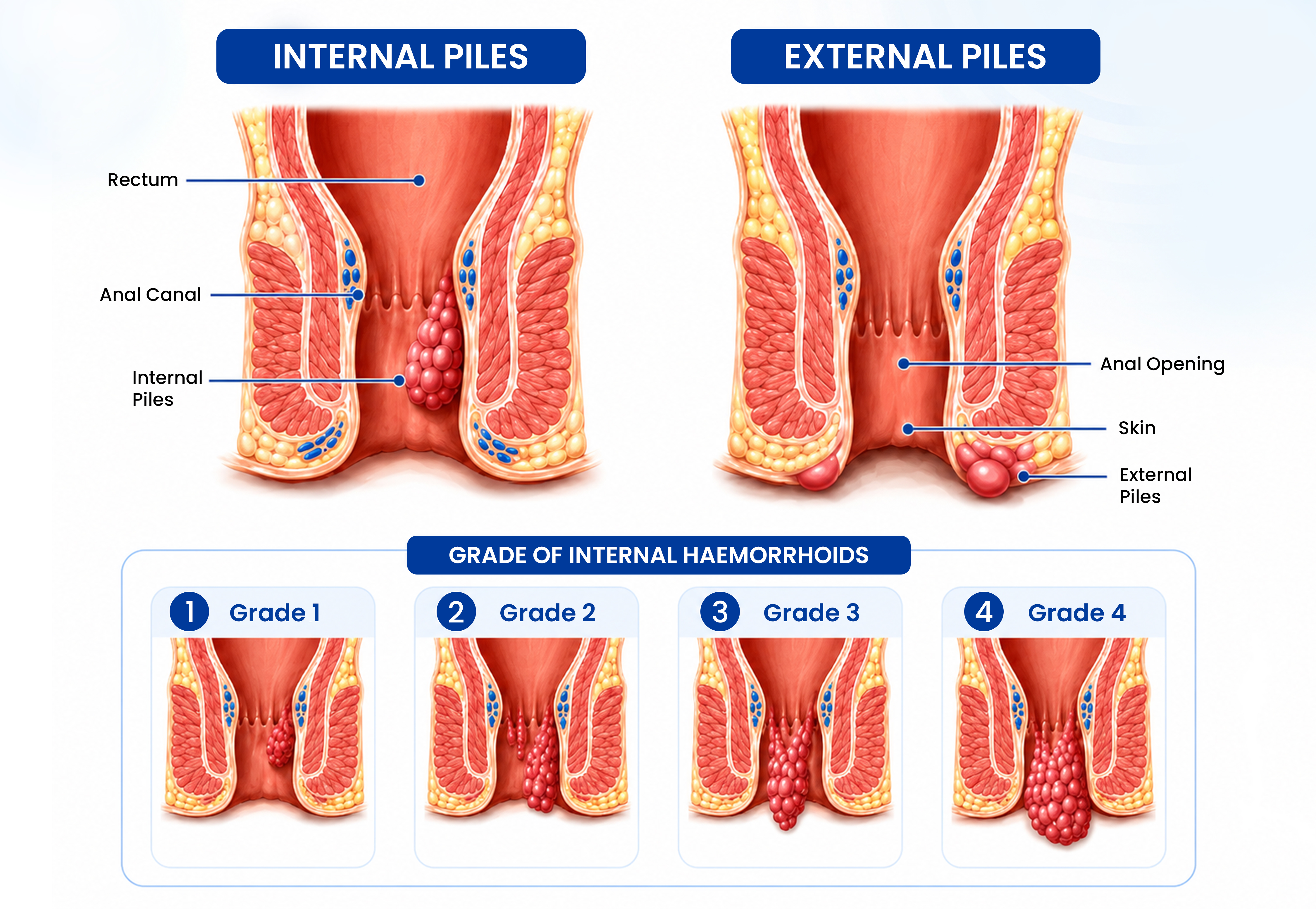 Medical illustration comparing internal and external hemorrhoids, labeling the rectum, anal canal, anal opening, and skin, with a visual guide showing Grades 1 to 4 internal hemorrhoids.
